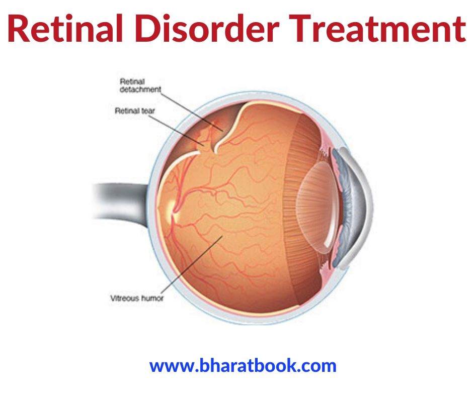 Retinal Disorder Treatment - Bharat Book Bureau